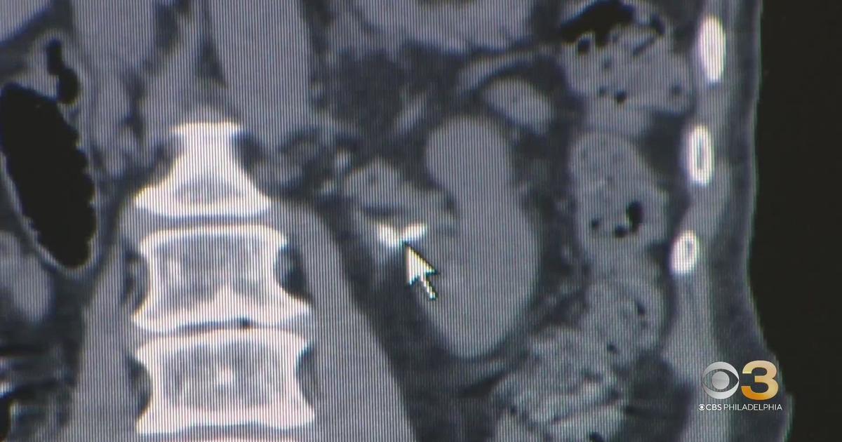 Rising temperatures, climate change may lead to increased risk of kidney stones, doctor says - CBS Philadelphia